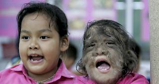 Mindestens 17 Kinder seien vom sogenannten "Werwolf-Syndrom" (Hypertrichose) betroffen. (Themenbild: Thailand 2006)
