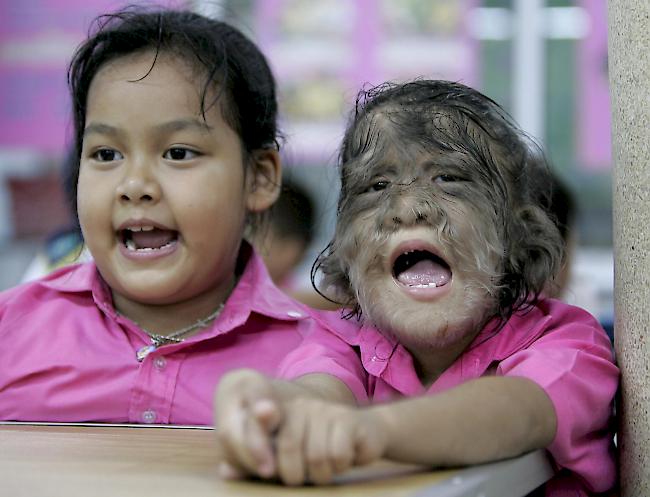 Mindestens 17 Kinder seien vom sogenannten "Werwolf-Syndrom" (Hypertrichose) betroffen. (Themenbild: Thailand 2006)